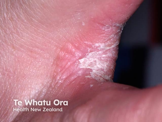Keratolytic winter erythema