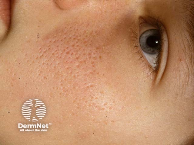 Keratosis pilaris faciei atrophicans