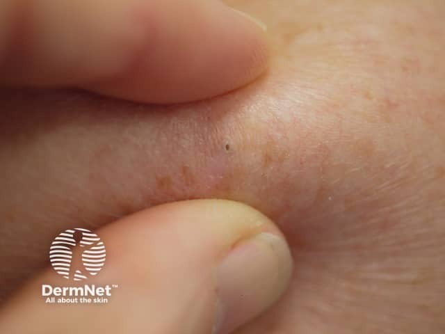 Palpating an epidermoid cyst - note this accentuates the punctum