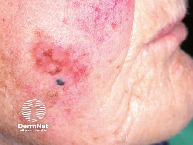 Lentigo maligna melanoma