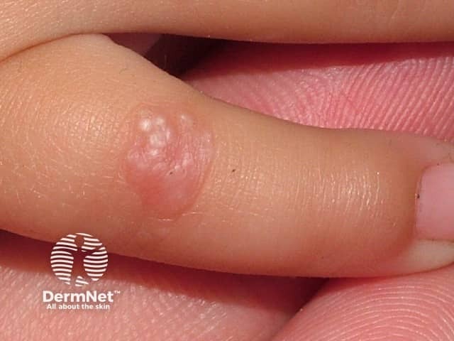 Epidermolysis bullosa