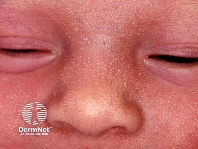Neonatal milia