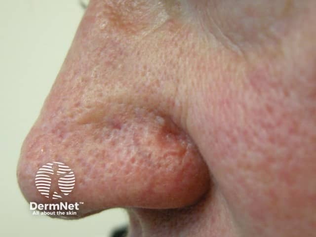 Sebaceous carcinoma