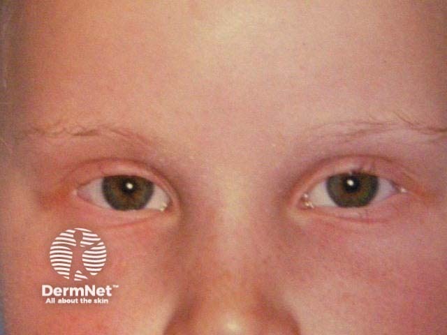 Alopecia areata