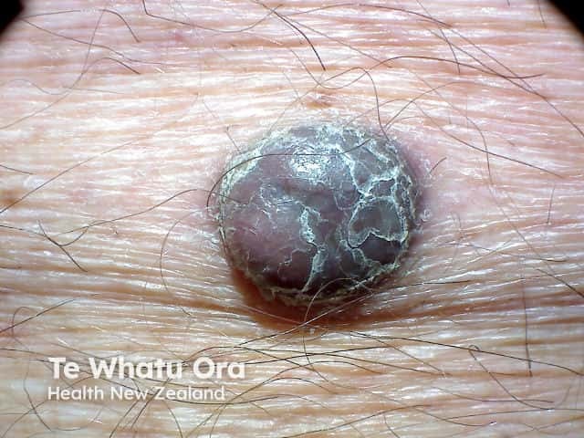 Nodular melanoma