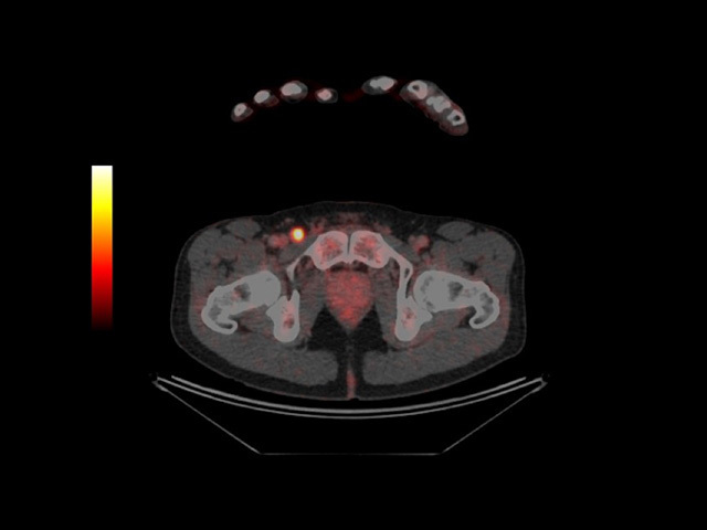 PET-CT scan revealing metastatic melanoma in groin