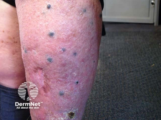 Metastatic melanoma