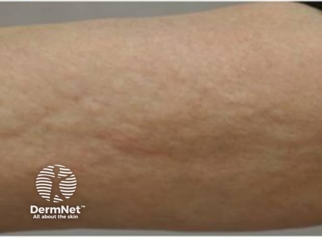 “Orange skin” thickening and a “groove sign”
