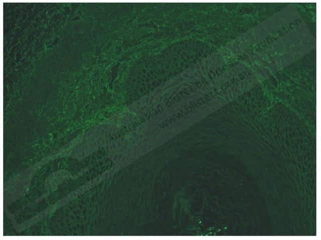 Pemphigus vulgaris