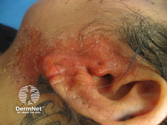 Contact dermatitis to disinfectant