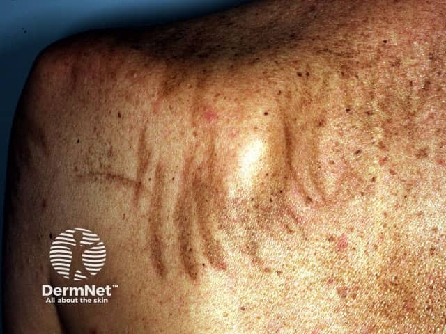 Pigmented streaks caused by bleomycin
