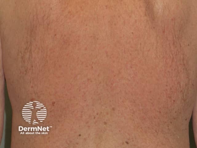 Rash due to vemurafenib