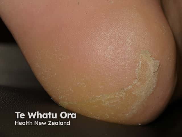 Keratoderma due to vemurafenib
