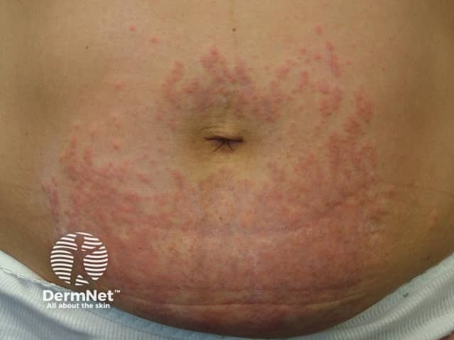 Polymorphic eruption of pregnancy
