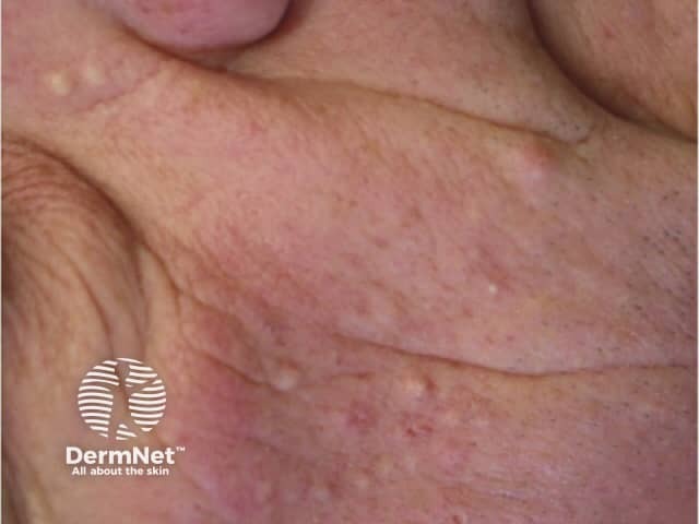 Folliculitis due to vemurafenib