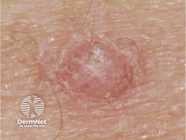 Close-up papilloma