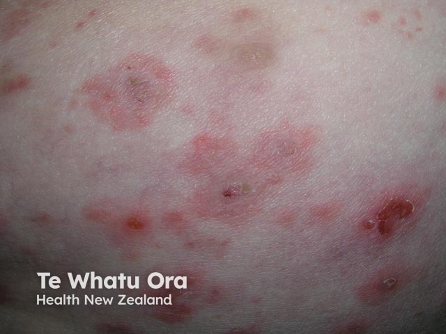 Bullous pemphigoid