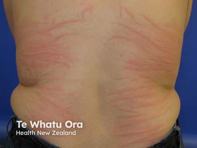 Dermographism: inducible urticaria