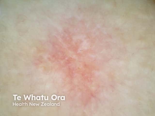 Superficial basal cell carcinoma dermoscopy