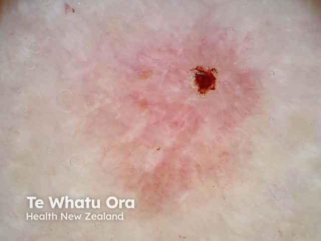 Superficial basal cell carcinoma dermoscopy