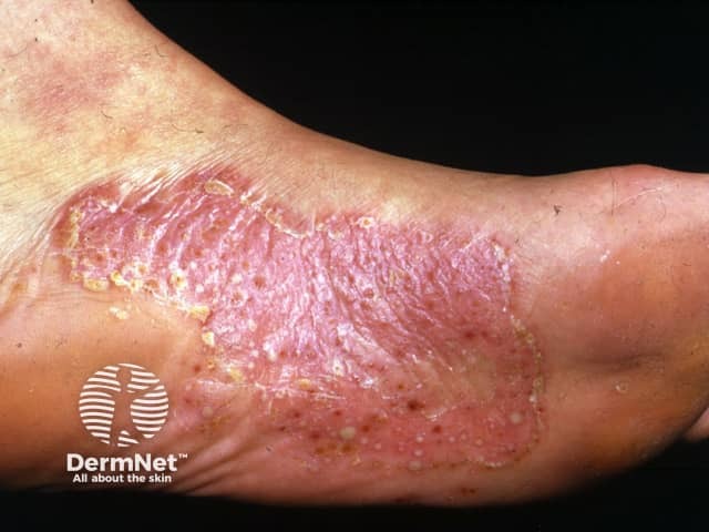 Pustules and rusty dots in a scaly plaque typical of PPP