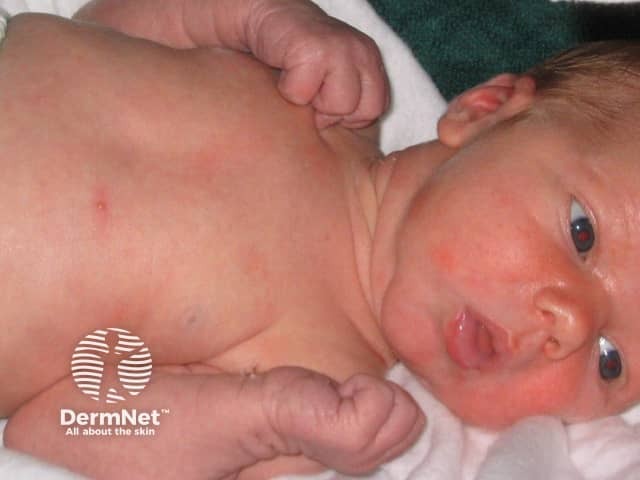 Erythema toxicum neonatorum