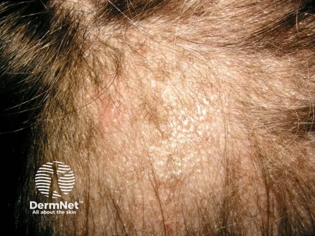 Tinea Capitis