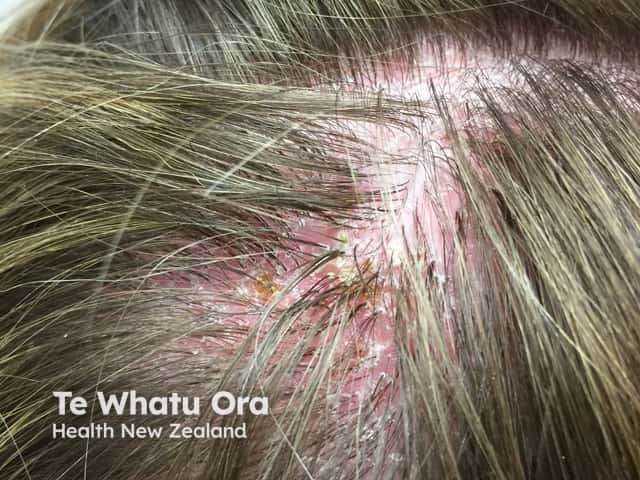 Folliculitis decalvans