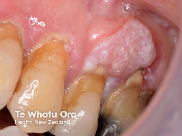 Alveolar cancer