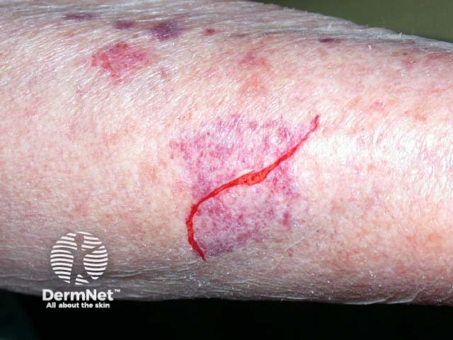 Skin fragility