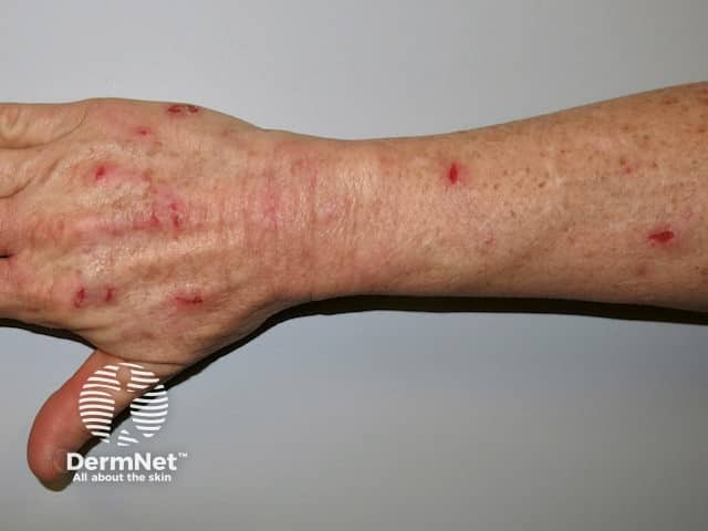 Skin picking