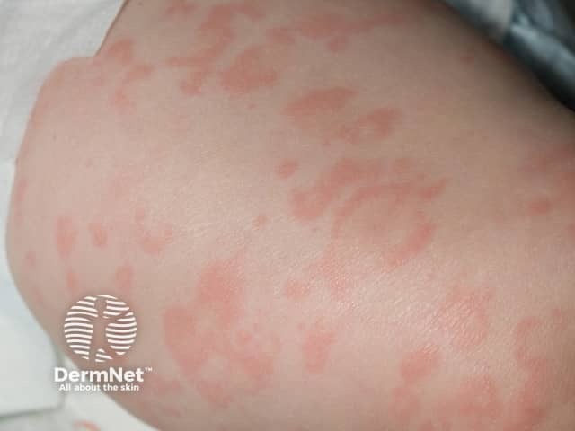 Close up of transient annular macular erythema 2 hrs after cold exposure