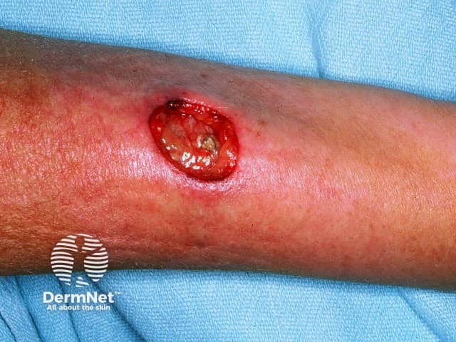 Ulcer