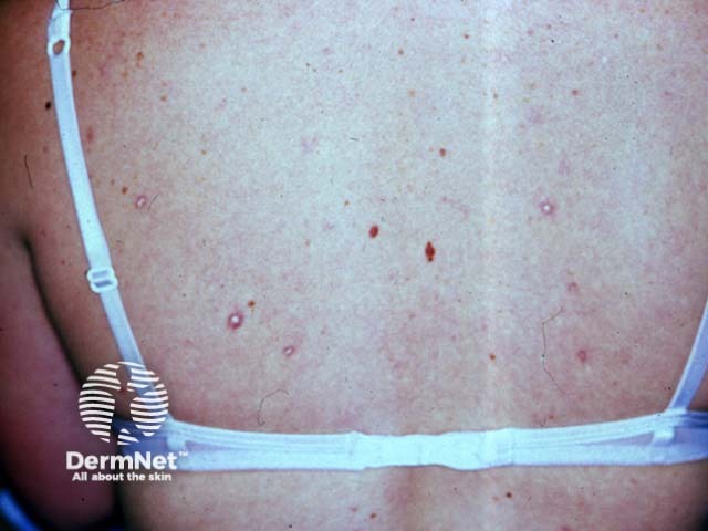 Degos disease