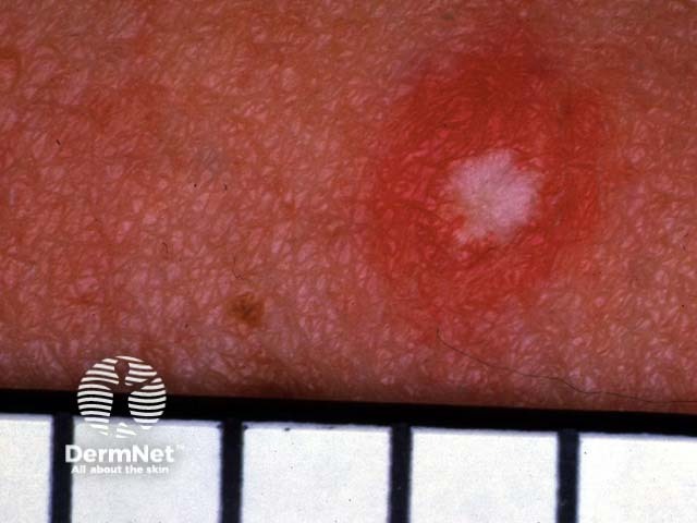 Degos disease