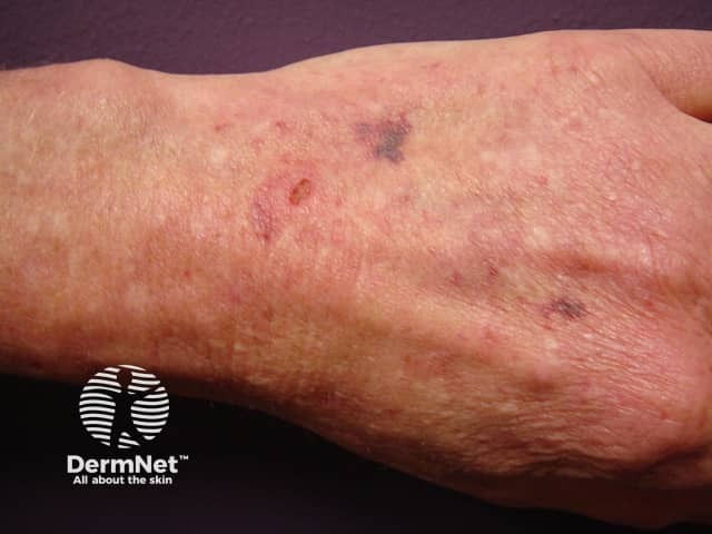 Skin fragility