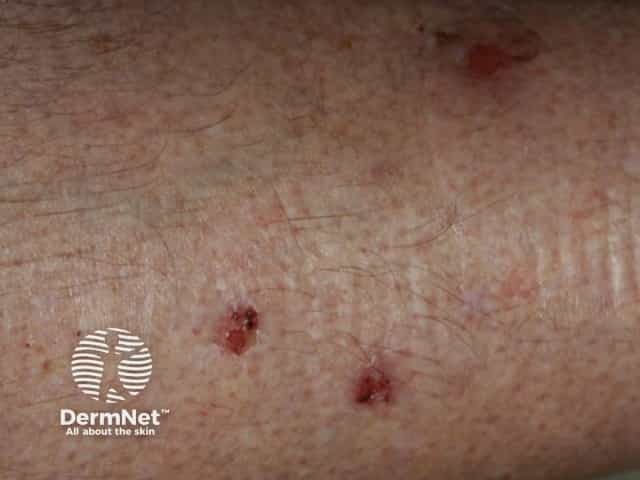 Small erosions from which fibres have been extracted from the skin