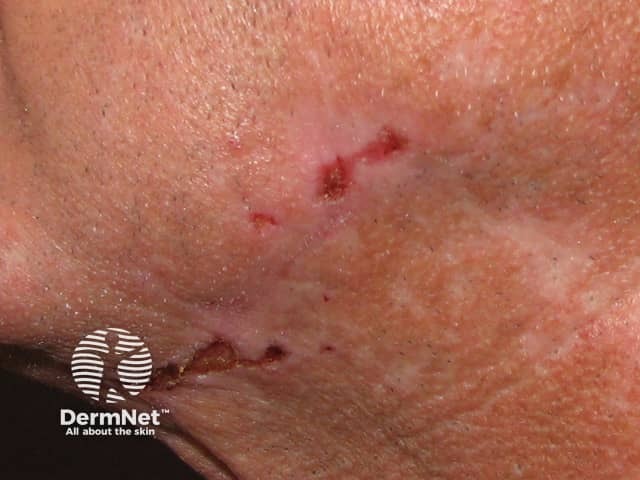 Excoriations and erosions from which fibres have been extracted