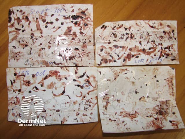 Material that has been extracted and collected by a Morgellons sufferer - microscopy confirmed that no parasites or micro-organisms were present