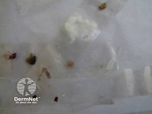 Microscopy of material provided by a Morgellons sufferer - they show dried serum, keratin and fibrous material