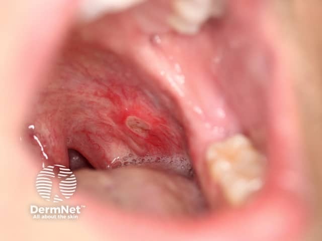 Aphthous ulceration