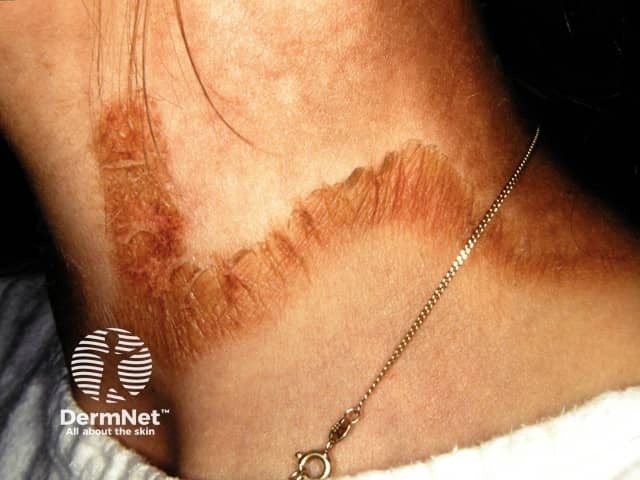 Pellagra