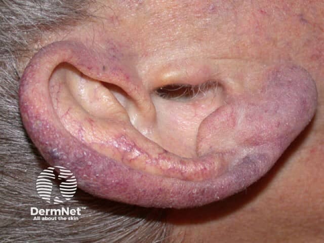 Cyanosis