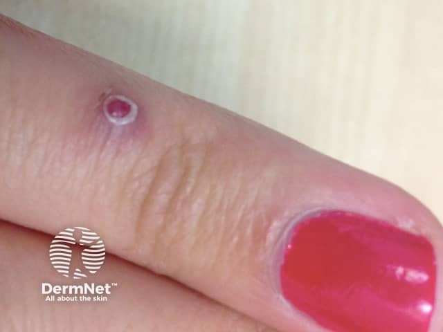 Pyogenic granuloma