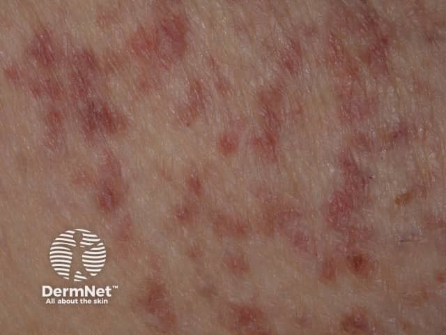 Diffuse cutaneous mastocytosis