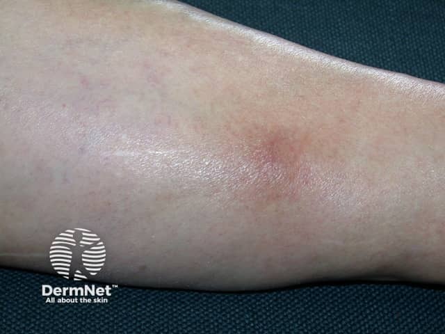Thrombophlebitis