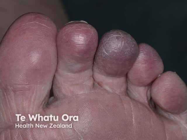 Acrocyanosis