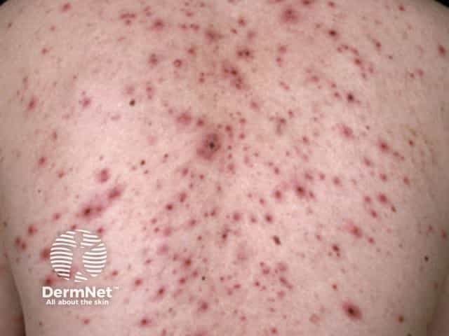 Varicella