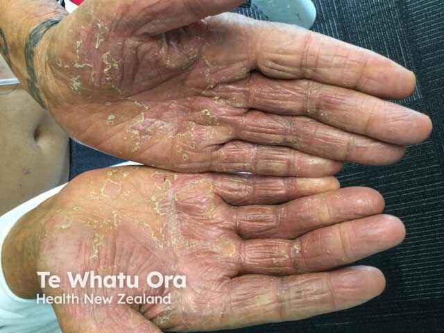  Diffuse scale and redness on the palms due to eczema