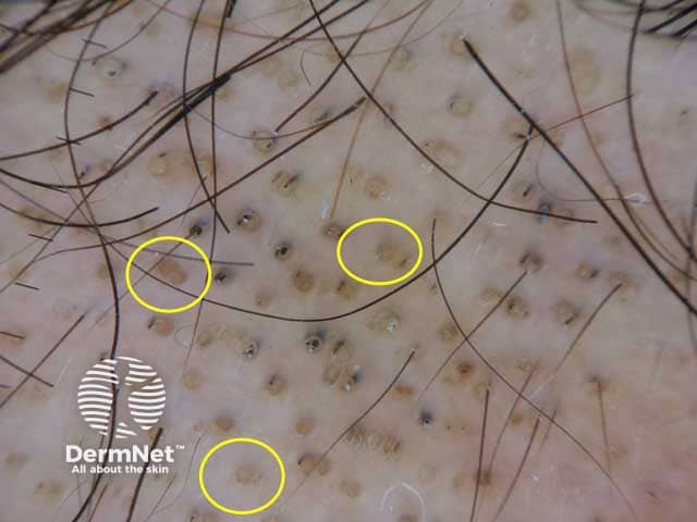 Dermoscopic image of alopecia areata showing yellow dots; follicular infundibula filled with keratinous material with no hair shafts. Black dots are also presented.